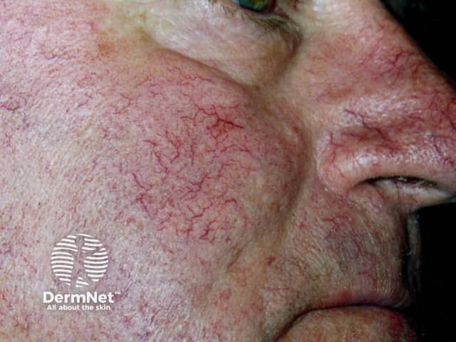 Gambar 1: Spider veins (telangiectasias). Credit: Dermnetnz.org